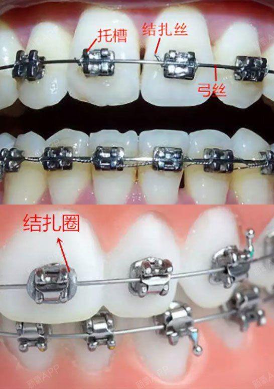 牙套结扎丝图解图片