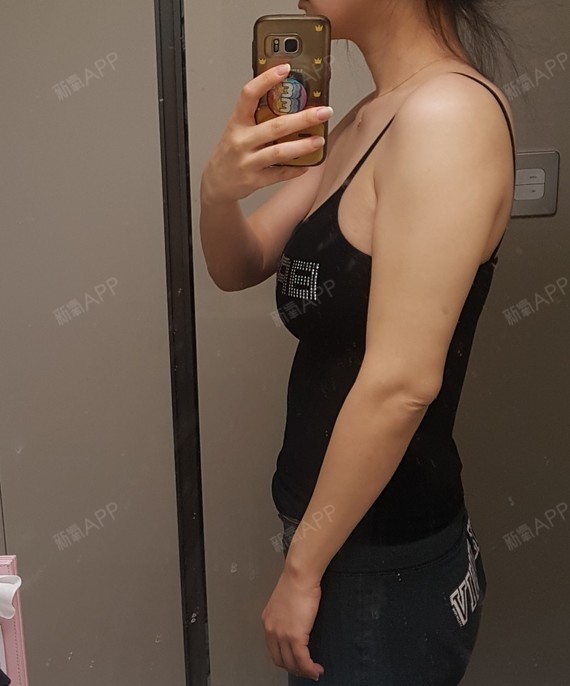 医院:韩国微塑整形医院项目:手臂环吸快速告别蝴蝶臂_圈子-新氧美容