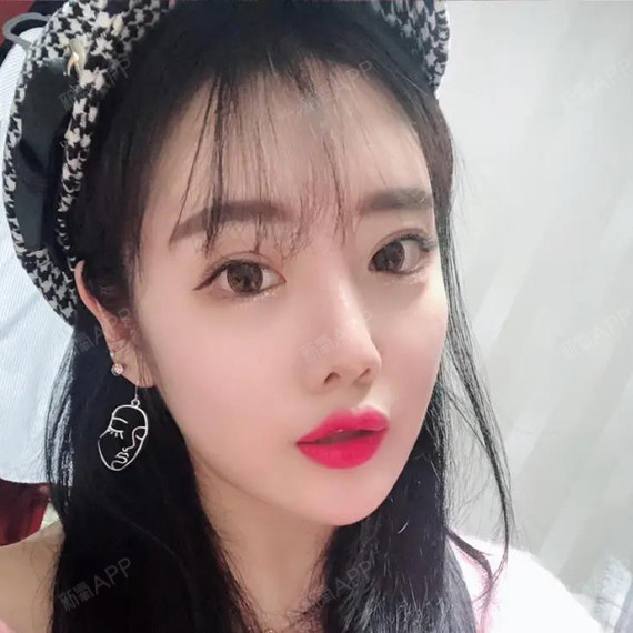 来聊聊我的小鼻子吧,已经2个多月的时间了,小巧玲珑_圈子-新氧美容