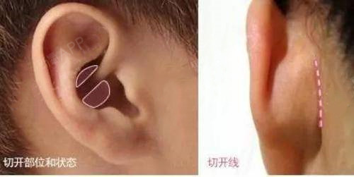 取了耳软骨 耳朵会怎么样 很多非常想做隆鼻的患者一 圈子 新氧美容整形