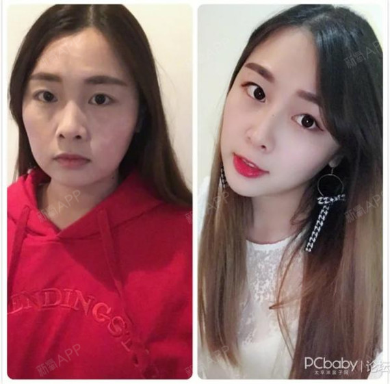 面部提升线雕视频_线雕面部提升术过程大揭秘_线雕面部提升