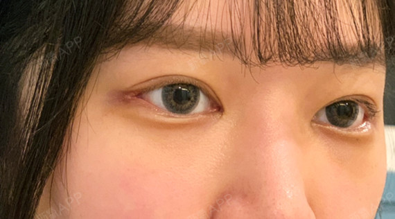 内眦赘皮矫正好不好_效果图_玲玲3322内眦赘皮矫正术后第31天_新氧