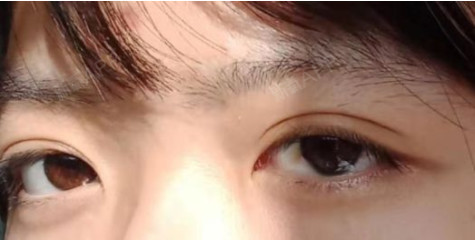 轻微内眦赘皮就一定要开眼角吗?