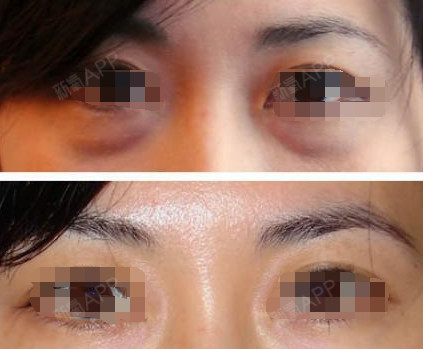 老阿姨眼袋眶隔释放失败案例告诉你眶隔脂肪释放填充泪沟副作用有哪些