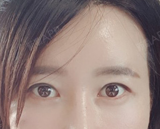 上眼睑去脂好不好_效果图_背袋裤上眼睑去脂术后第33天_新氧美容整形