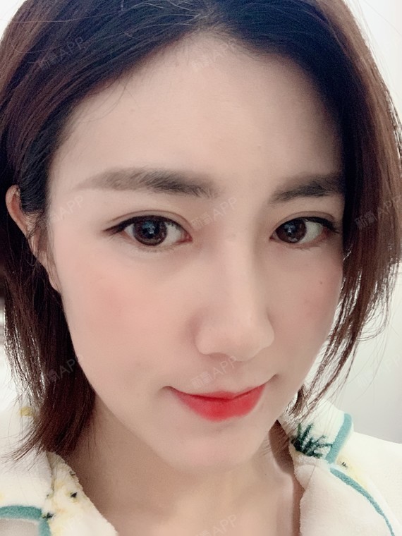 【青岛伊美尔5s重睑术】现在基本没啥大问题了,可以_圈子-新氧美容