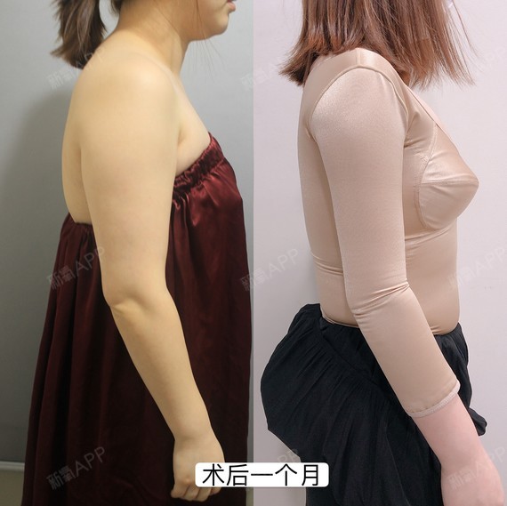 吸脂瘦背部好不好_效果图_爱豆豆123吸脂瘦背部术后第14天_新氧美容