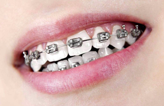 平反这位妹妹把钢牙套戴的好好康