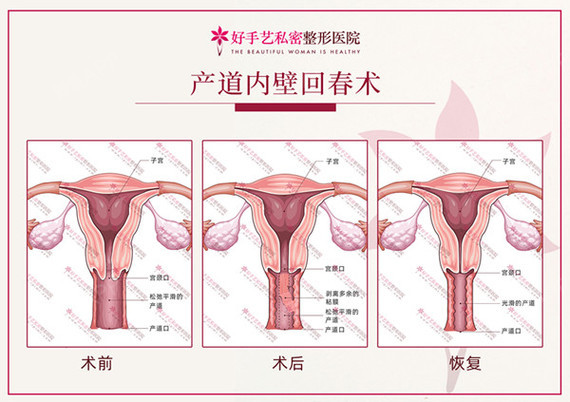 经产妇宫颈口图片