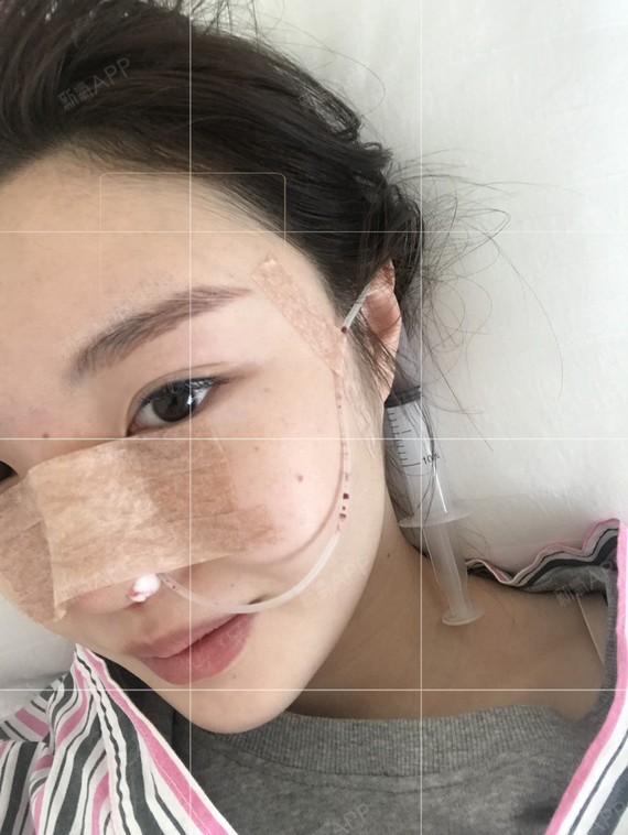 合肥鼻部多项好不好_效果图_大头慧慧鼻部多项术后第0天_新氧美容整形