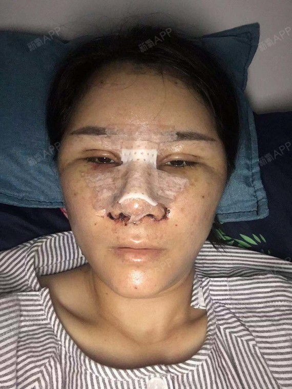 术后第四天鼻子还是感觉胀胀的稍微有点不舒服,早上醒_圈子-新氧美容