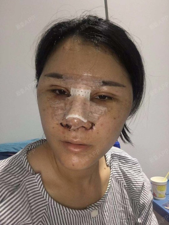 术后第四天鼻子还是感觉胀胀的稍微有点不舒服,早上醒_圈子-新氧美容