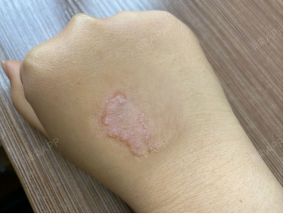 真没想到会长成这个样子,肉鼓起来,摸上去坚硬,一点都不是烟疤那样子