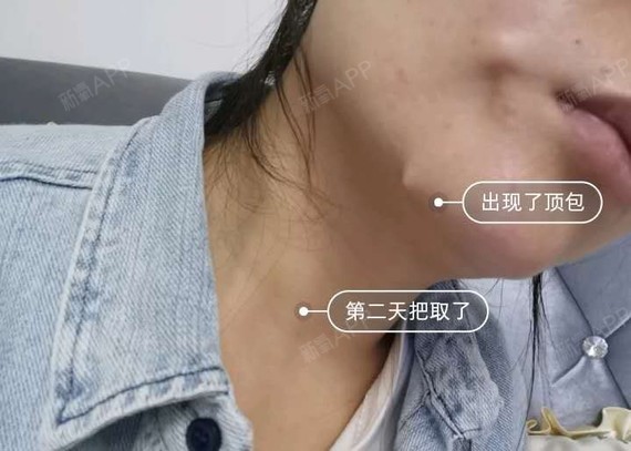 线雕后脸上顶出个包还能能摸到凸起的线怎么办