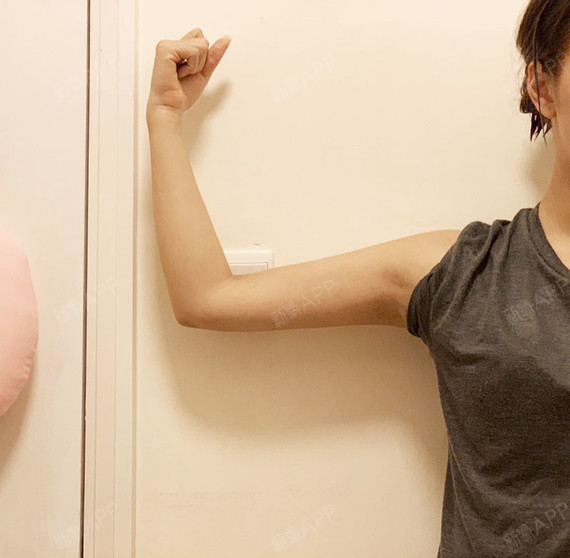 我又来分享了~ 吸脂4个月的手臂,上臂吸完很瘦了,_圈子-新氧美容整形