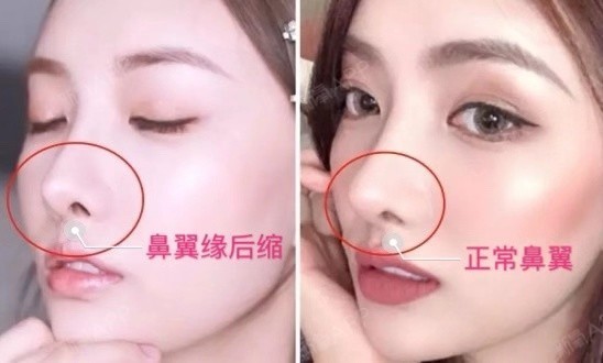 都是鼻翼缘后缩惹的祸!