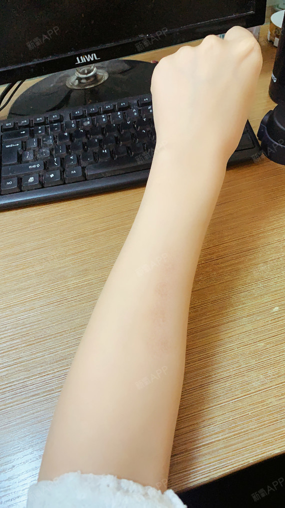 终于去掉了讨厌的烟疤!不仔细看一点也看不出_圈子-新氧美容整形