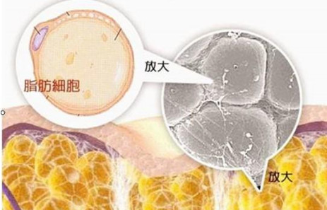 脂肪填充硬结怎么溶解,姐姐脂肪填充部位硬,自救之路_圈子-新氧美容