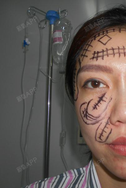 【哈尔滨星璨整形】【中下面部线雕】上了岁数的老阿姨_圈子-新氧美容