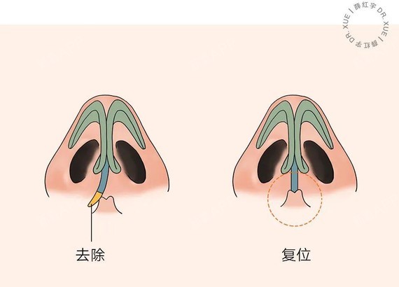 底部的歪曲,需要做 鼻中隔软骨复位 .
