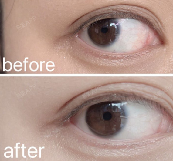 从小就会被人叫金鱼眼真的很讨厌,今天和大家分享一下关于凸眼的一些