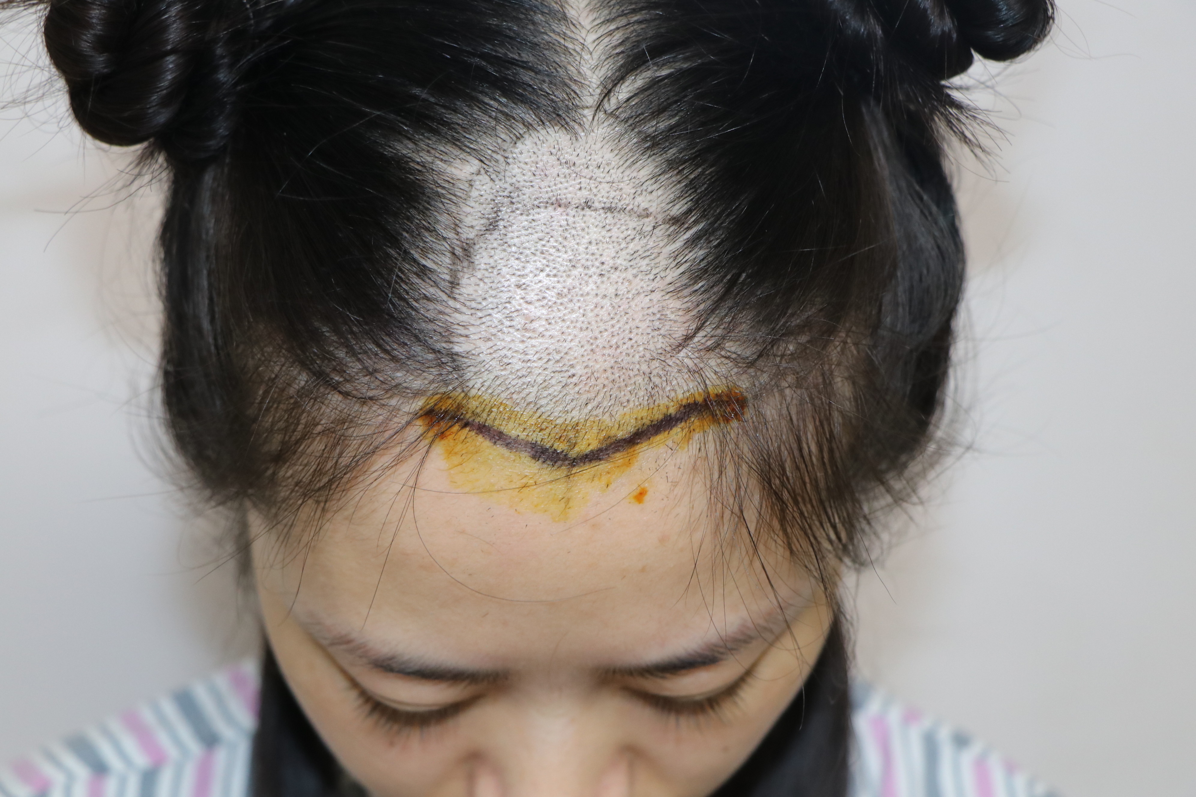 头顶加密植发# 顶部位于头皮中部与枕部之间.与发_圈子-新氧美容招挝