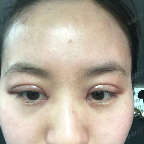 双眼皮术后第一天,术后肿胀但是还能接受,我做眼睛的_圈子-新氧美容