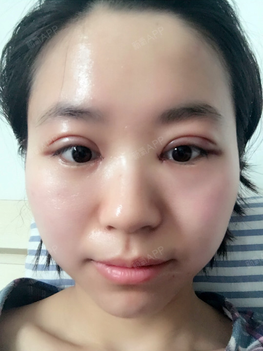 双眼皮术后第二天,但是今天就要拆掉了啦,拆完纱布就_圈子-新氧美容
