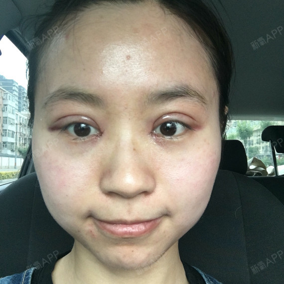 双眼皮术后第一天,术后肿胀但是还能接受,我做眼睛的_圈子-新氧美容