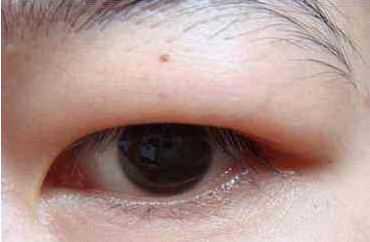 没有附着在皮肤,仅附着于睑板则为单眼皮; 如果眶隔内脂肪肥厚过多,或