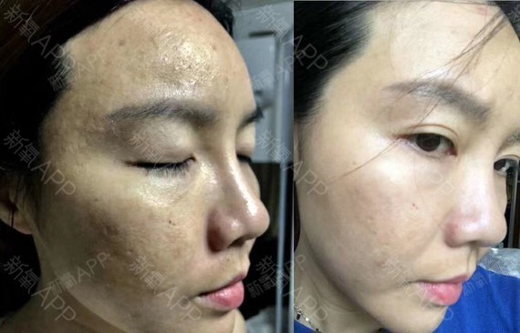 伊肤泉微针第0天微针美肤5次效果