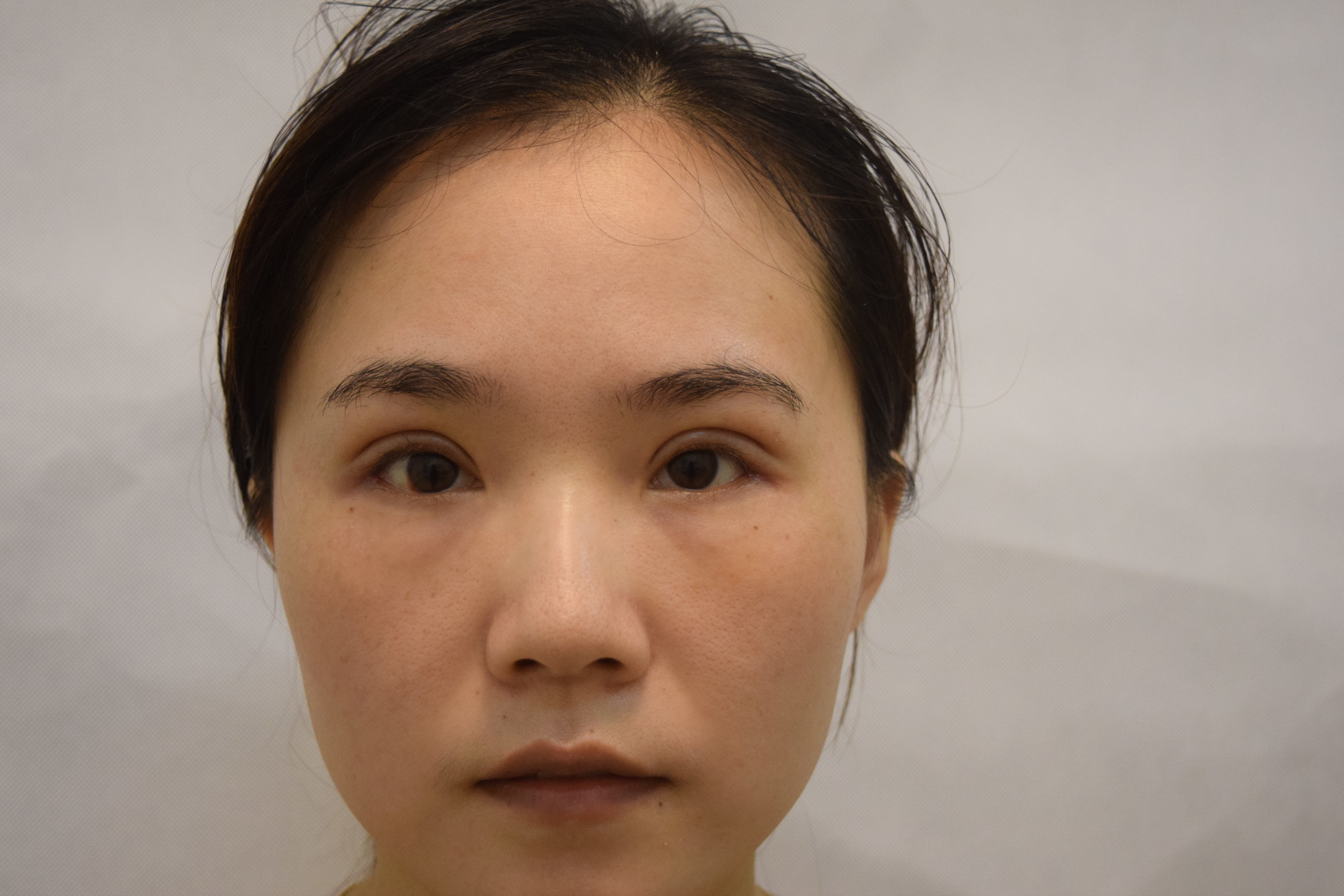 三亚维多利亚医疗美容医院李善医生怎么样_好不好_挂号_整形案例-新氧