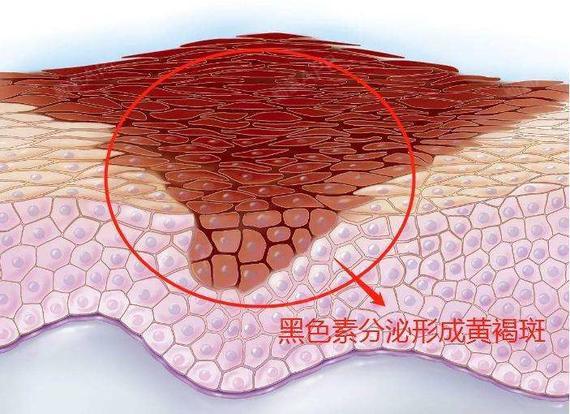 汞斑的分类图片图片