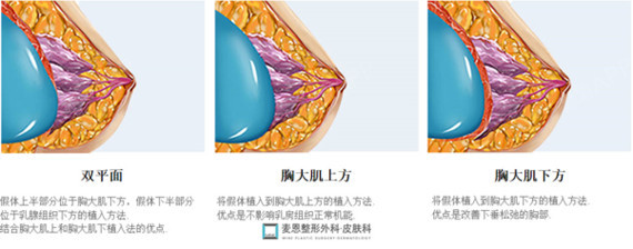 随着胸部整形行业的不断发展手术使用的设备越来越高端
