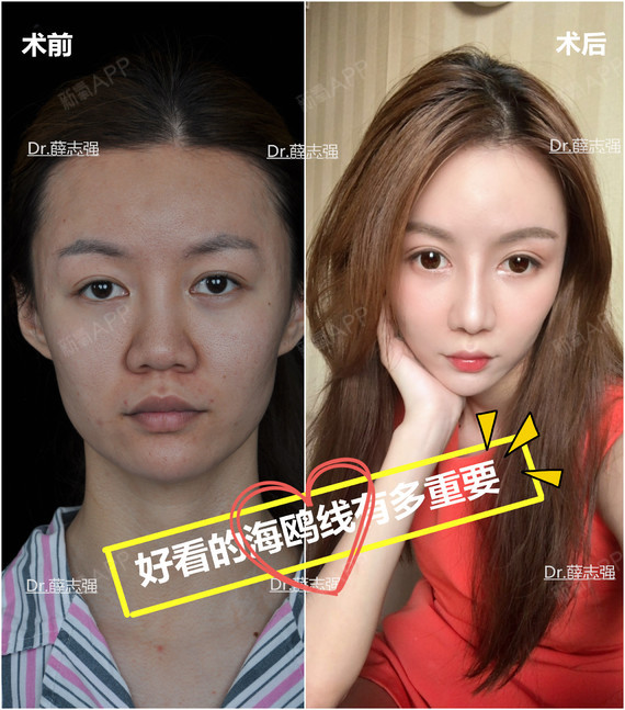 鼻尖的美学表现点有很多,海鸥线就是其中一个.