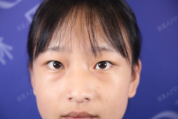 术前面诊内双双目无神略显土气