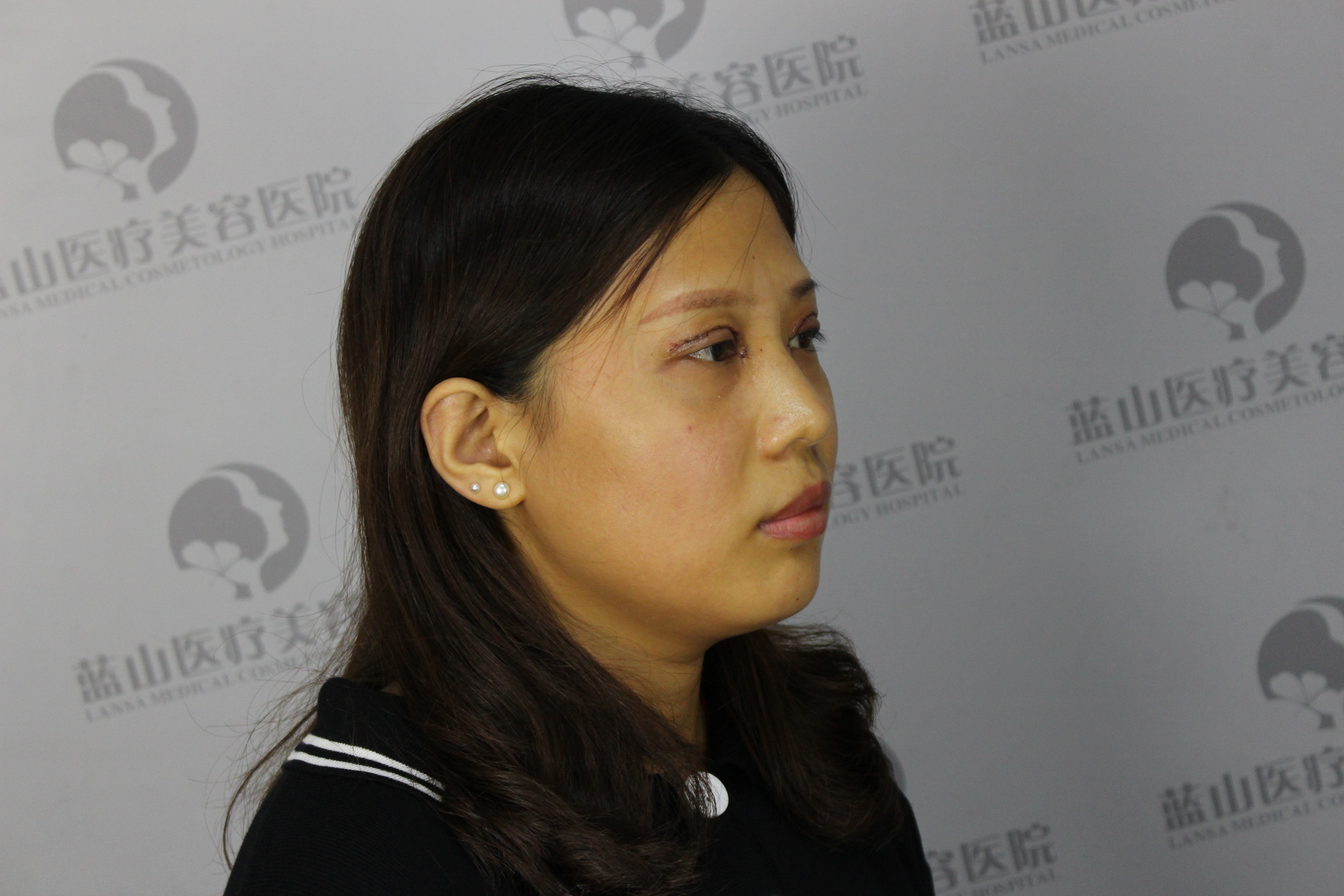 蓝山·卢闯主任·双眼皮第2天】来蓝山清洁,换药,_圈子-新氧美容整形