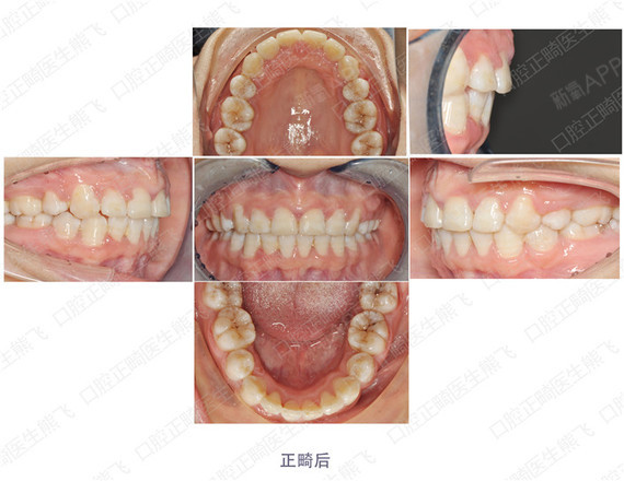 临床检查,x线头影测量,模型及照片分析,该患者被诊断为 上下牙列拥挤