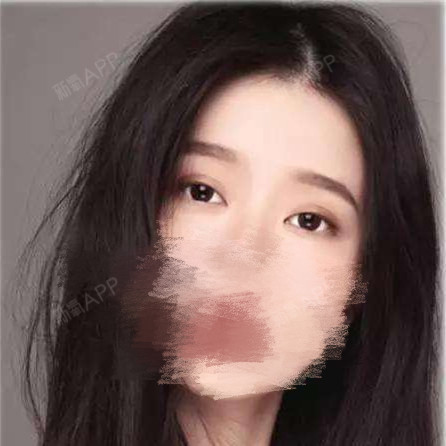 眼睛大,并不代表眼_圈子-新氧美容整形