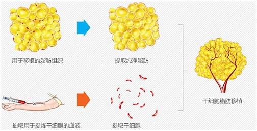 2,有效保障脂肪存活--存活高 离心,净化,提纯 有效保障脂肪