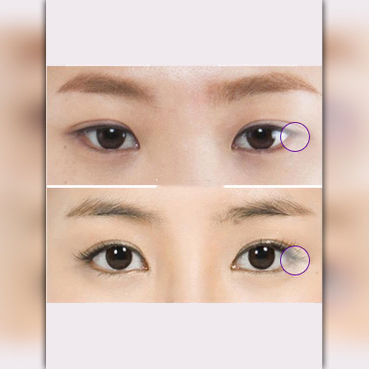 什么样的人适合开外眼角呢?