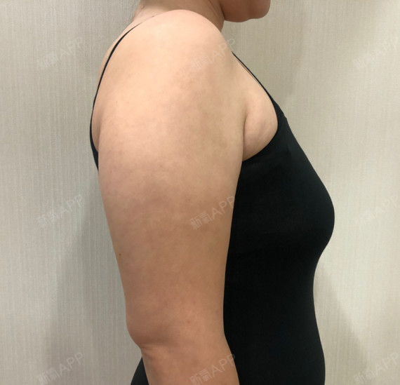 副乳会危害身体健康吗(副乳对身体有什么影响吗?)