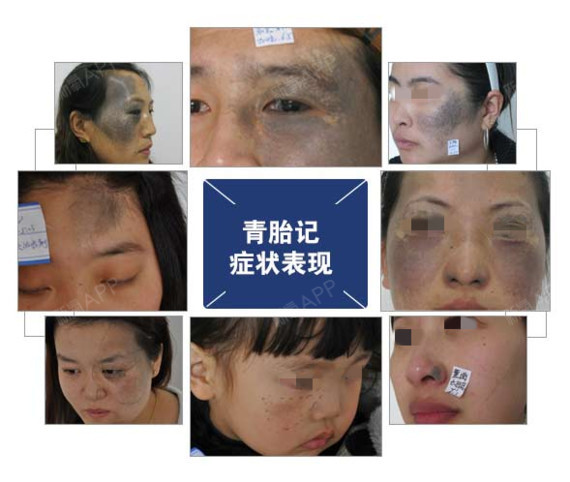 胎记激光能治青胎记吗