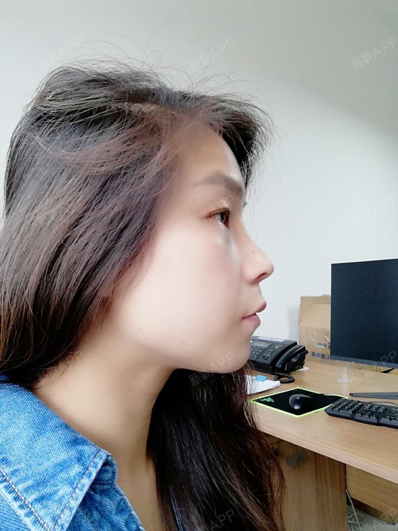 大家帮我看一下做了15天的半肋隆鼻,侧面这个效果是_圈子-新氧美容