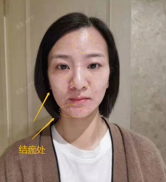 超皮秒还可以祛痘祛色沉?