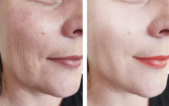 黄金微针射频四大优势