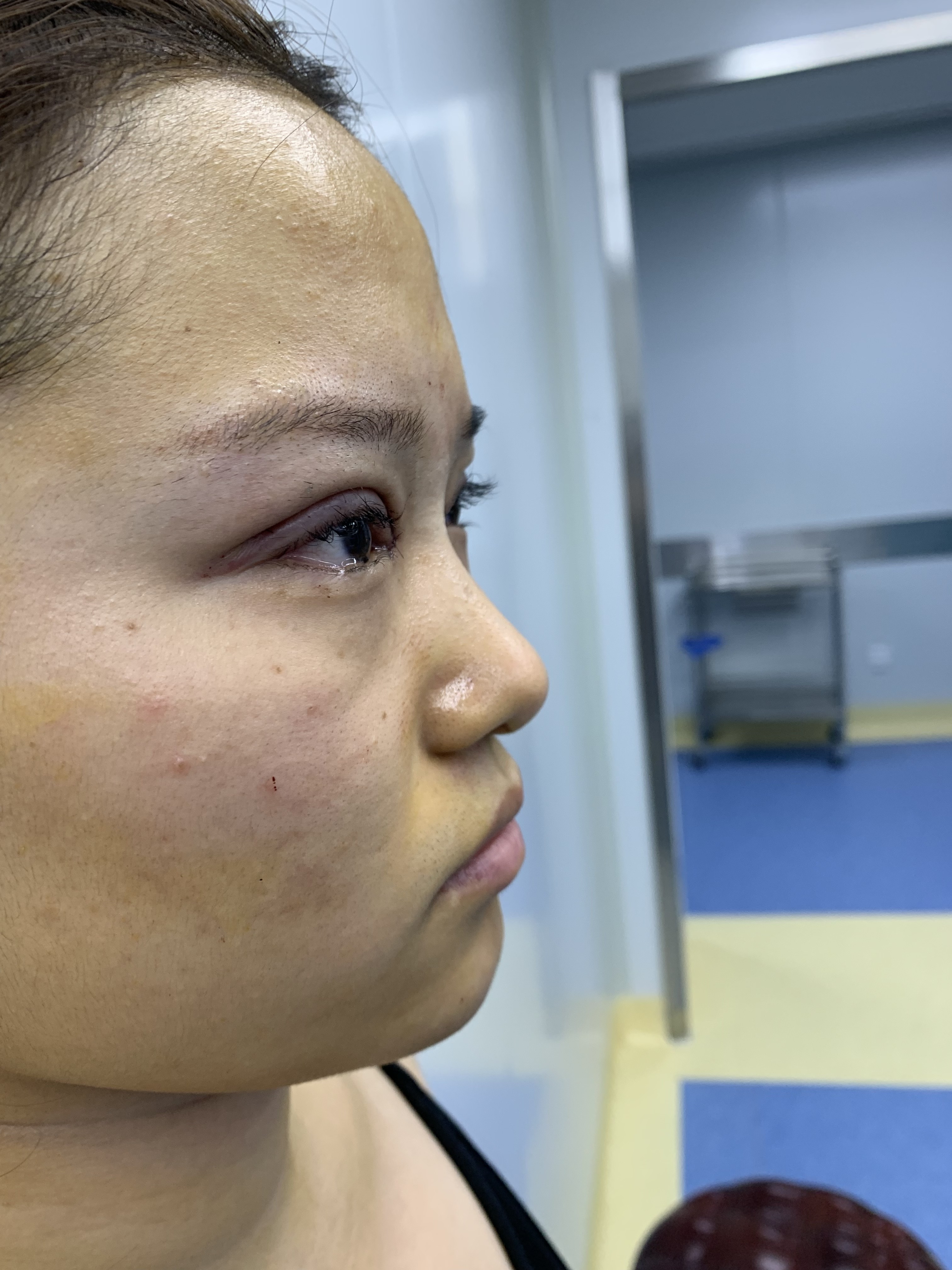 【石家庄康体整形医院耿祎楠院长隆鼻】【术后第一天】_圈子-新氧美容
