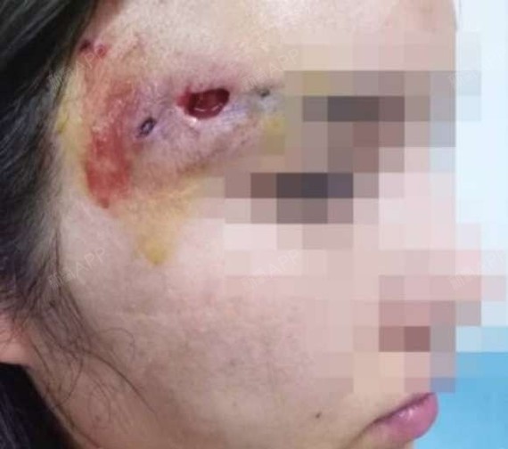 惊,小秦线雕二十天脸又肿了,线雕感染的症状是什么?竟然越治越严重