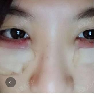 外切去眼袋导致干眼眼疼,外切去眼袋手术后遗症来的猝不及防