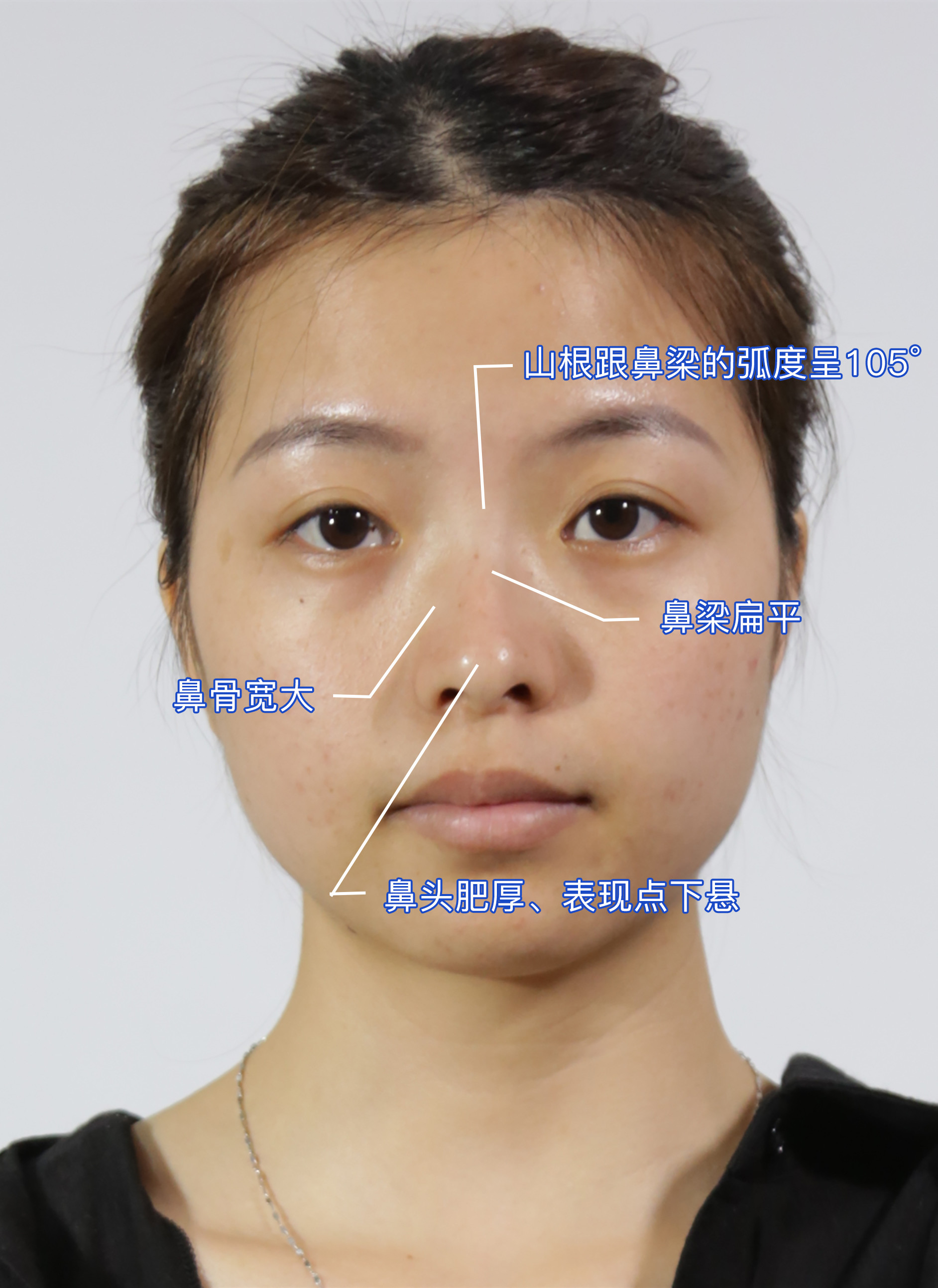 【广州曙光官方案例】扁塌鼻拯救计划项目:综合隆鼻缺_圈子-新氧美容